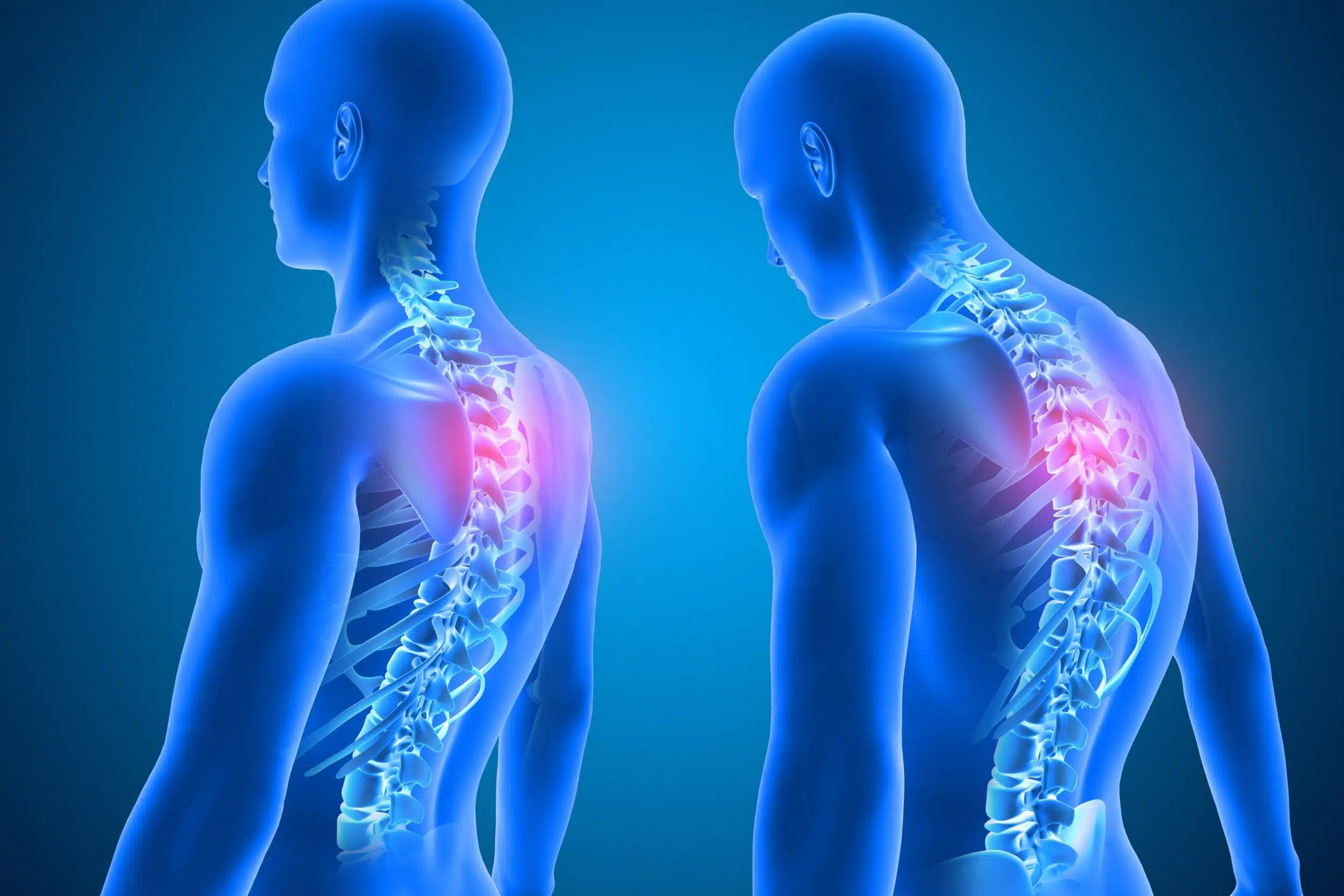 Graston Technique®: Effective Strategies to Treat Upper Crossed Syndrome