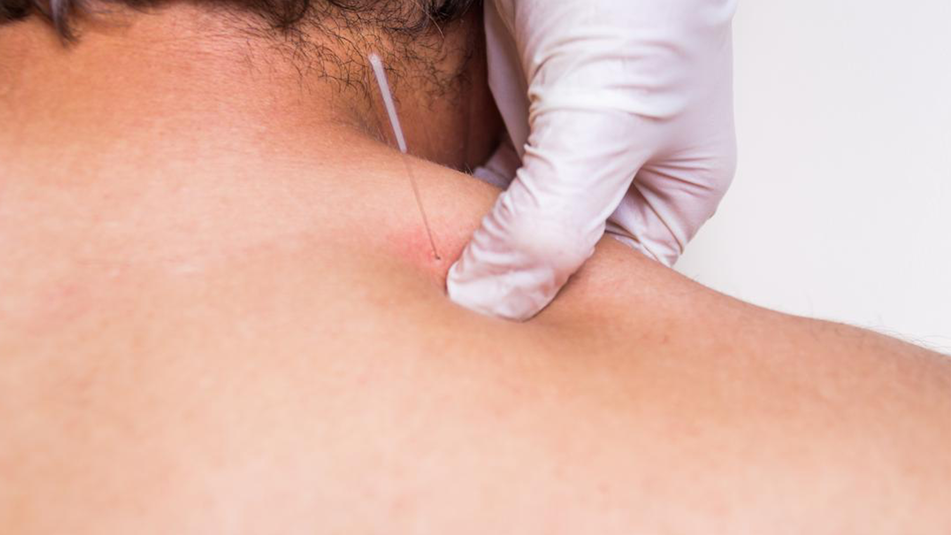 ShortCourseProductPics_-CombiningDryNeedling